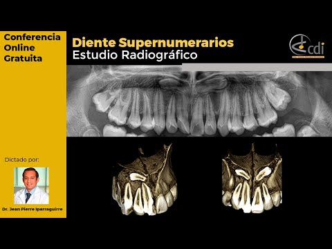 Video: ¿Qué síndromes se asocian con los dientes supernumerarios?