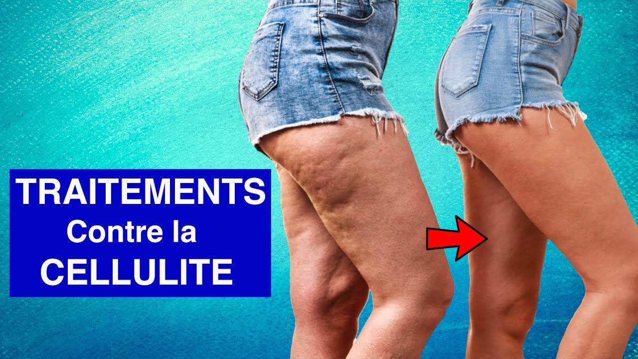 CELLULITE : Explication + Traitements Efficaces - YouTube