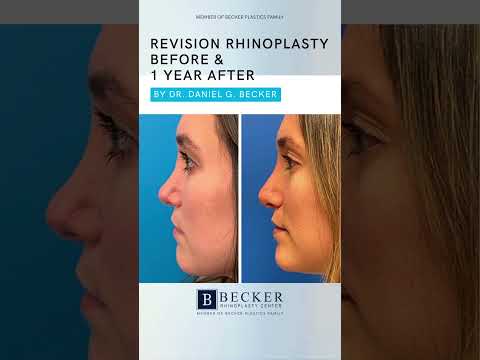 Video thumbnail: One Year After Revision Rhinoplasty 👃☺| Dr. Daniel Becker · Becker Rhinoplasty Center