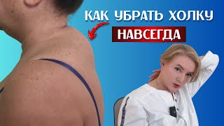 Как убрать вдовий горб на шее при помощи горячей воды и деревянной ложки
