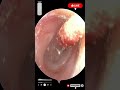 विशाल ब्लॉकेज हटाकर कान पूरी तरह साफ 😲 #कानसफाई #Medical #EarCare