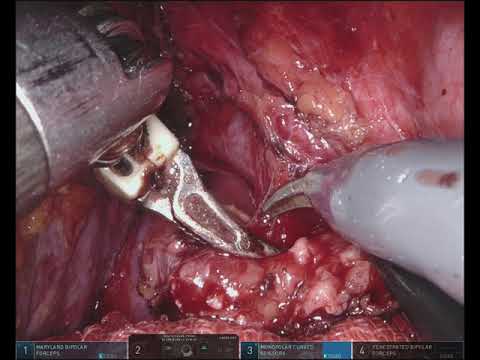 Robotic completion radical cholecystectomy and lymphadenectomy  gallbladder cancer