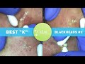 "K's" Best Blackhead Extraction Compilation Part #2