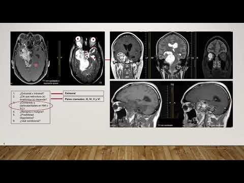 Video: Cómo diagnosticar el astrocitoma: 12 pasos (con imágenes)
