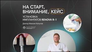 Установка имплантата Renova R-1 | Доктор Максим Копылов