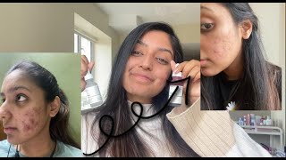 How I Cleared My Acne | Indian Skincare | The Ordinary