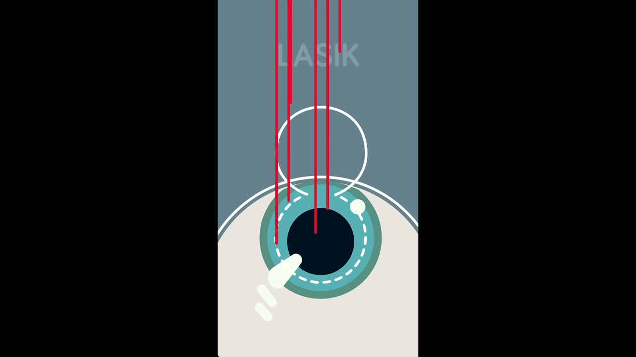 How Does Laser Eye Surgery Actually Work