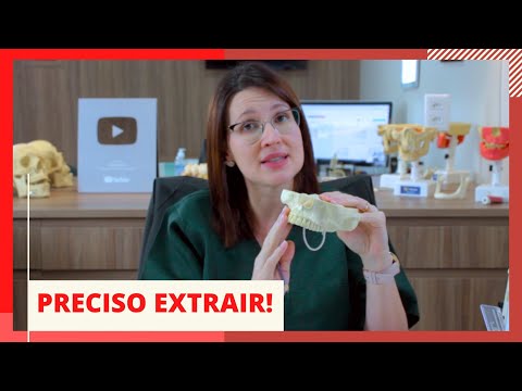 Vídeo: Os dentes supranumerários são genéticos?