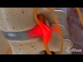 Discectomy medical animation  infuse medical