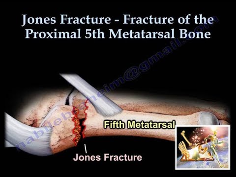 Jones Fracture - Everything You Need To Know - Dr. Nabil Ebraheim