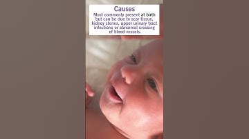 3 Must-Knows about Uretero-pelvic junction (UPJ) obstruction & Pyeloplasty