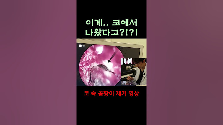 코 속 곰팡이 제거영상 진균성 축농증(부비동염) #shorts