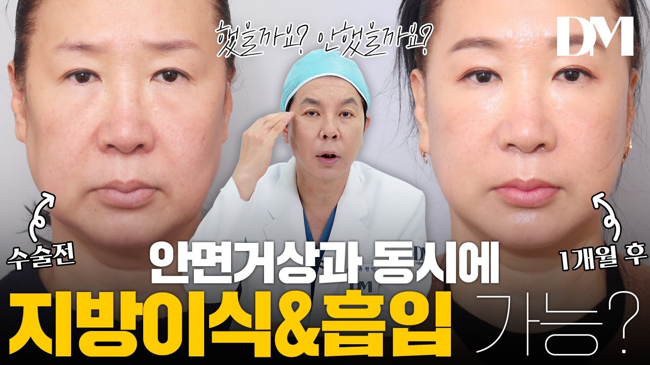 안면거상 할 때, 지방이식&지방흡입을 같이 해야 하냐구요..?! 😑 #안면거상 #지방이식 #지방흡입