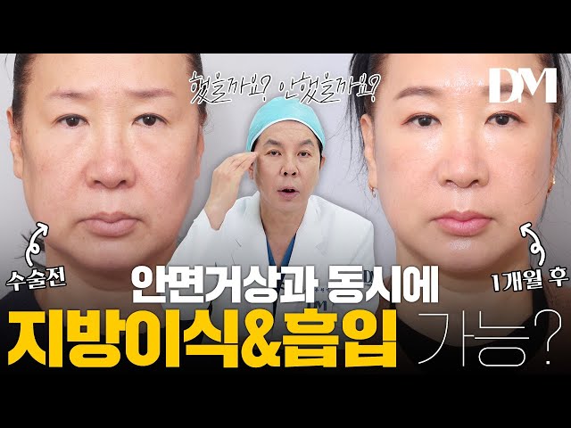 안면거상 할 때, 지방이식&지방흡입을 같이 해야 하냐구요..?! 😑 #안면거상 #지방이식 #지방흡입
