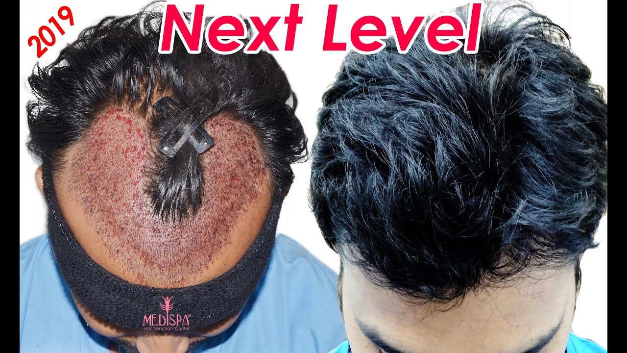 Hair Transplant Results