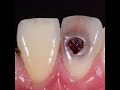Chữa sâu răng được thực hiện đúng cách như thế nào?