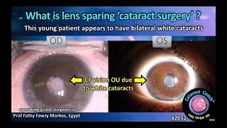 CataractCoach™ 2052: What is lens sparing 'cataract surgery' ?