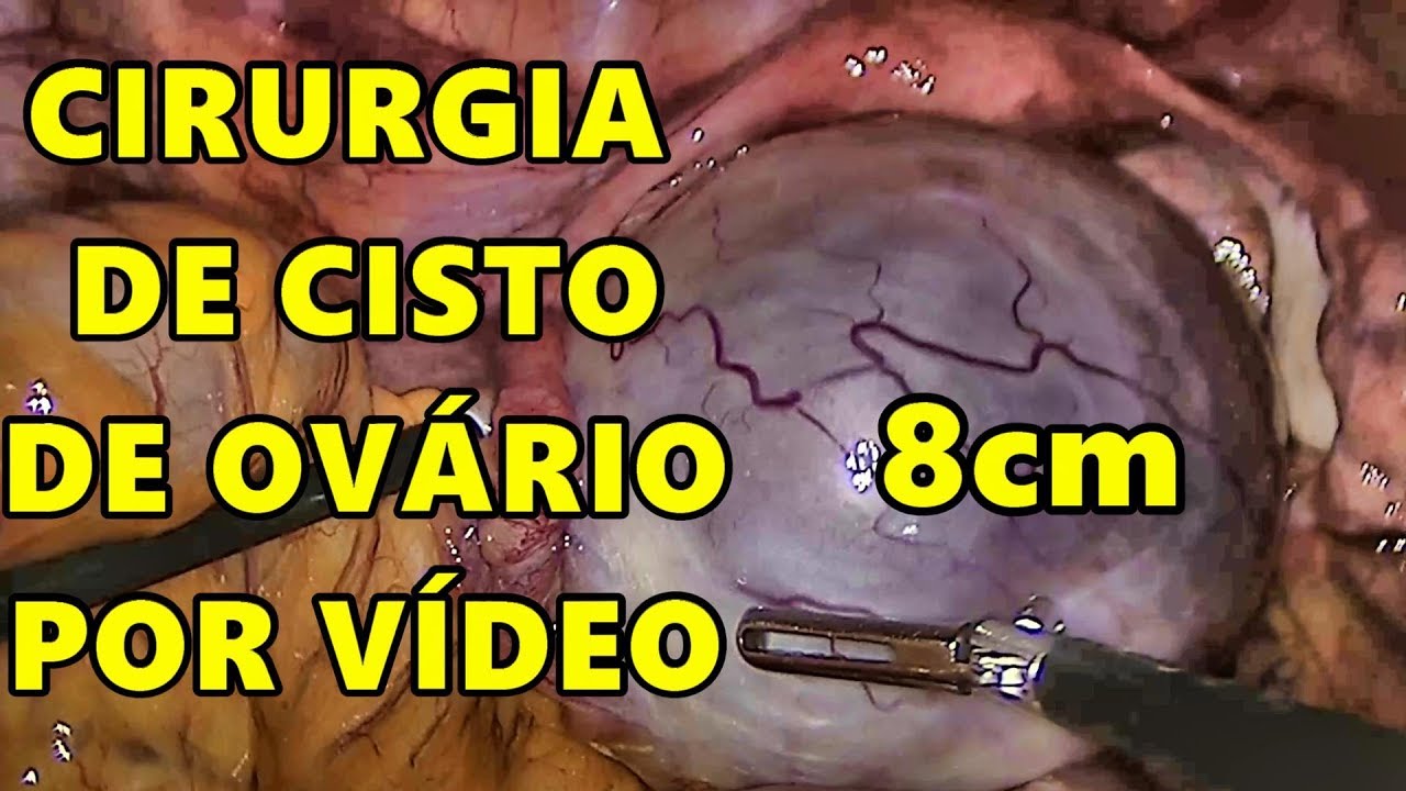 Retirada do Ovário > Cirurgia e Recuperação da Ooforoplastia