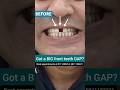 BIG Front Teeth Gap Makeover Without Braces Dr Srishti Bhatia Smilemakeover BIG Front Teeth Gap Makeover Without Braces Dr Srishti Bhatia Smilemakeover