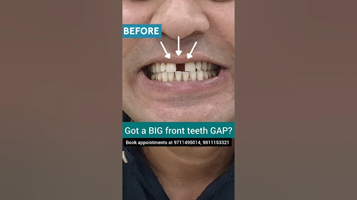 BIG Front Teeth Gap Makeover without Braces; Dr. Srishti Bhatia #smilemakeover