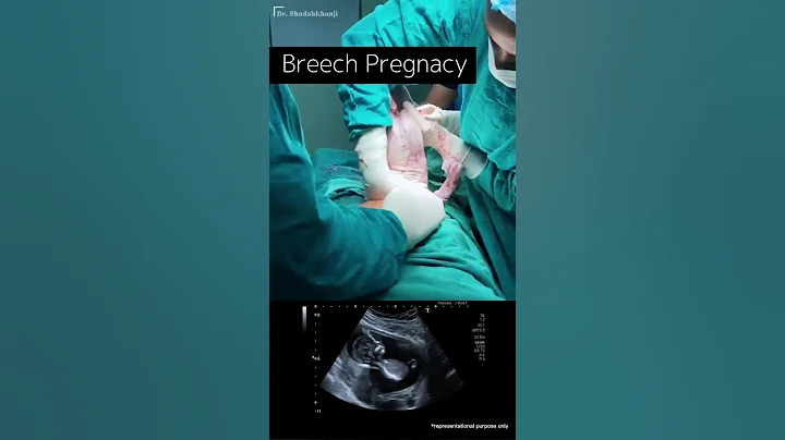 Caesarean Section for Breech Baby | Breech Pregnancy - DayDayNews