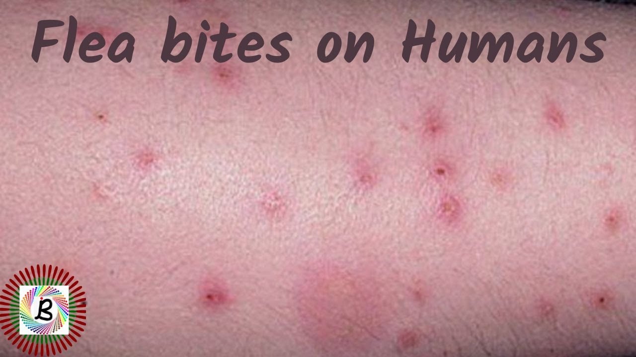 How To Identify Flea Bite Allergies On Humans