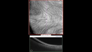 Identification of Suprachoroidal Viscoelastic With Swept-Source Optical Coherence Tomography