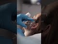 How long does swelling last after dermal filler?