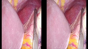 위점막하종양 절제를 위한 싱글포트 위 부분절제술 (설상절제술) solo single port gastric wedge resection for submucosal tumor