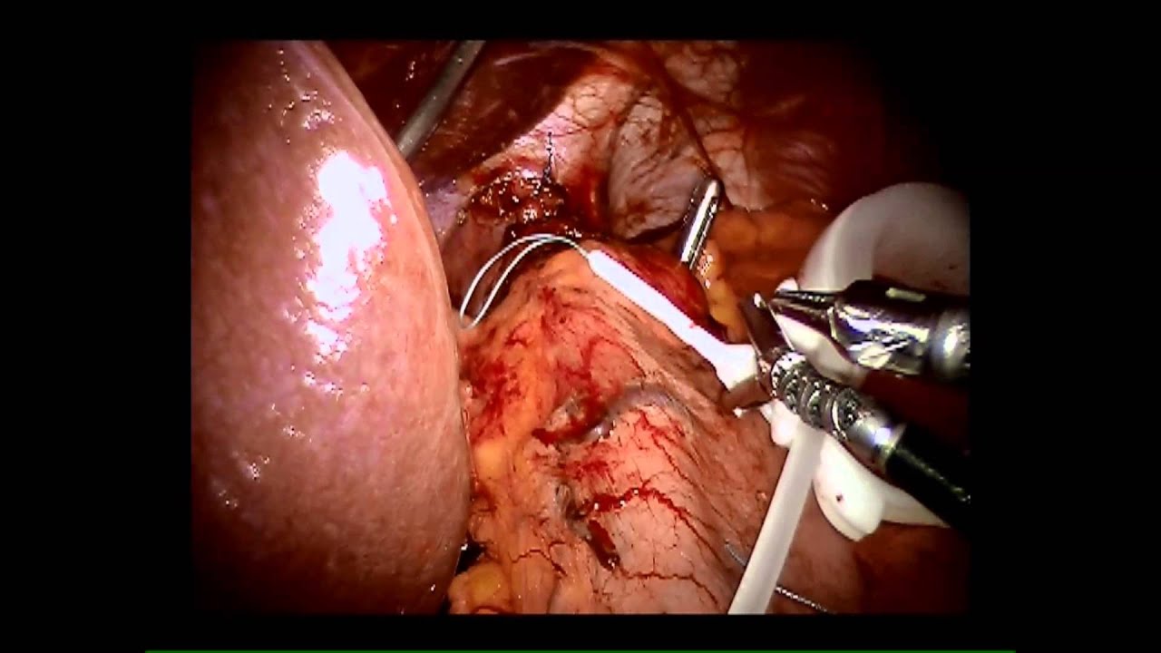 paraesophageal hernia repair and gastric banding houston zoo