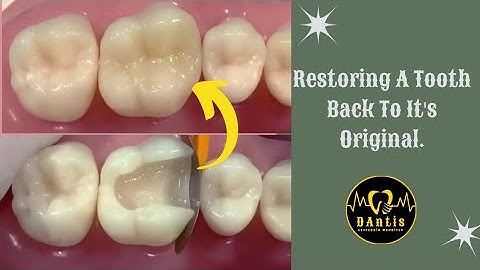 Making the Patient Smile Confidently Again. Restoration a molar tooth from cavities. #restoration