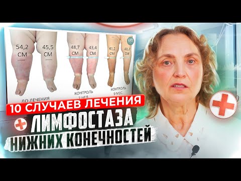 Отеки ног.  Как лечить лимфостаз нижних конечностей.