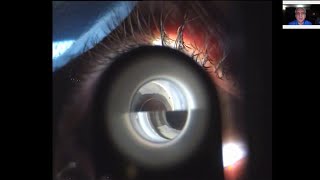 Glaucoma Cupping Case