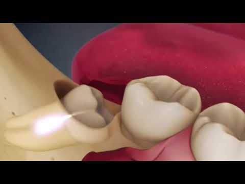 Video: Diş odontoplastiyası nədir?