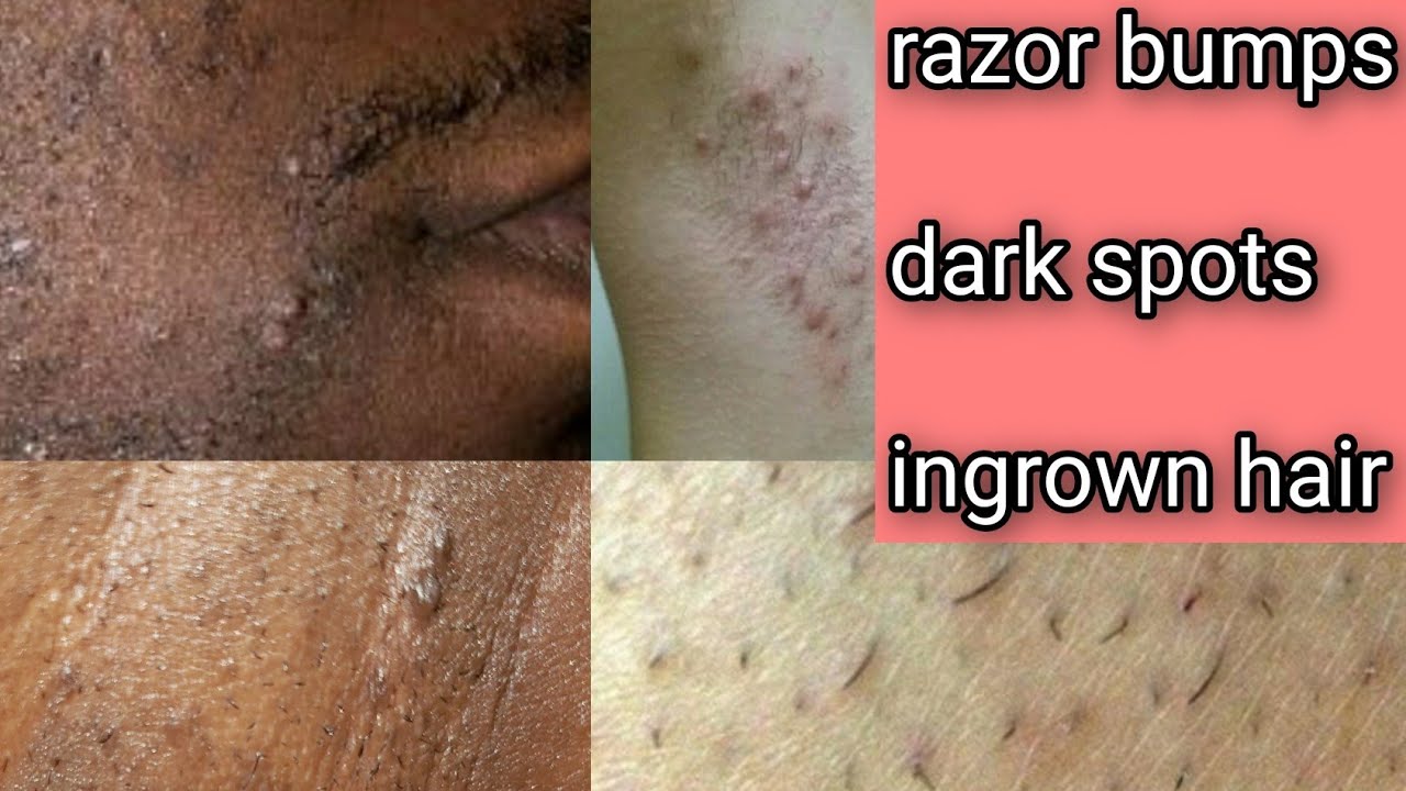 HOW TO GET RID OF RAZOR BUMPS, DARK SPOTS AND INGROWN HAIR. YouTube