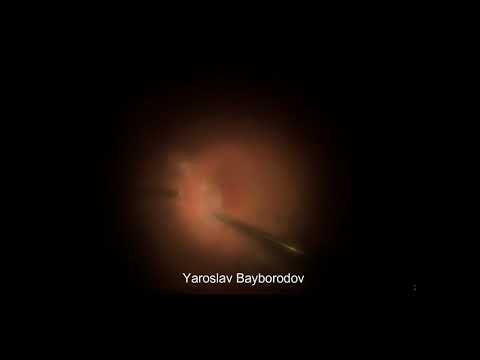 Пересадка сеткатки (аутологичная) при рефрактерном макулярном разрыве
