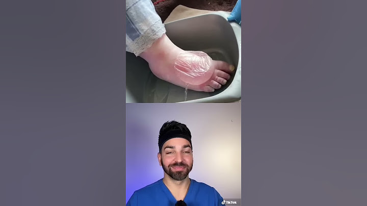 BIGGEST Blister I’ve Seen | Doctorly #shorts