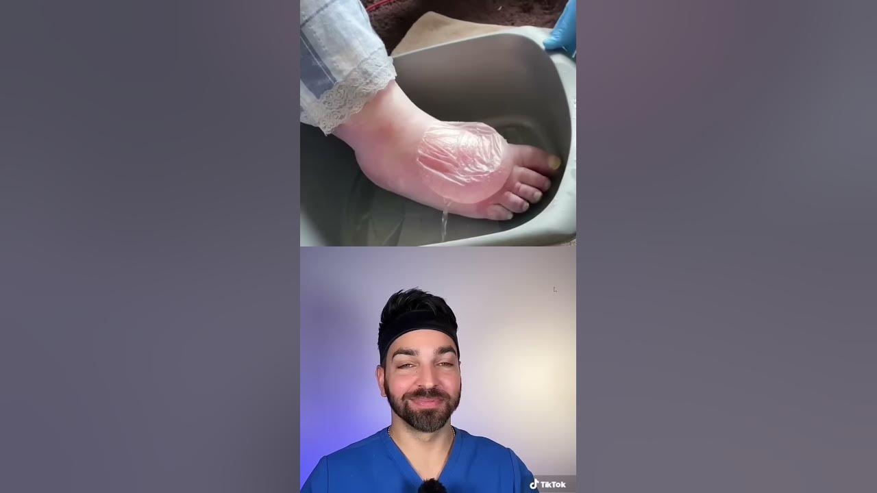 BIGGEST Blister I’ve Seen | Doctorly #shorts