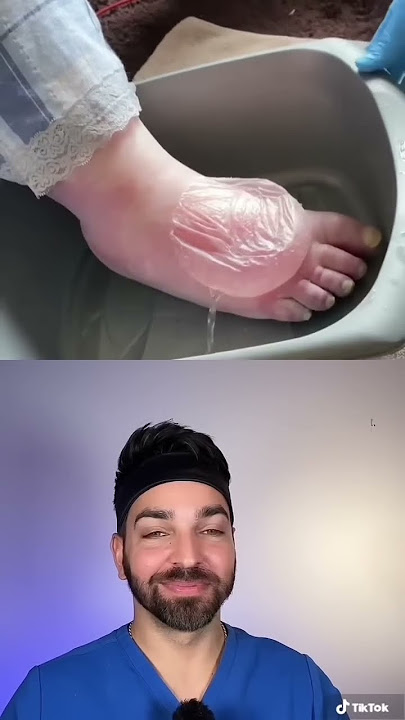 BIGGEST Blister I’ve Seen | Doctorly #shorts
