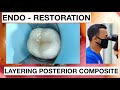 Step by step layering composite endo  resto molar
