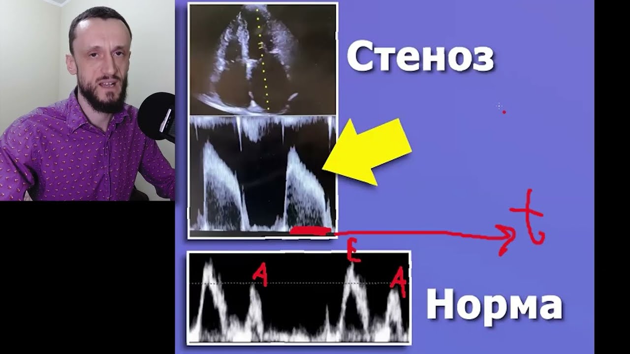 Стеноз Митрального Клапана | УЗИ сердца | Для врачей