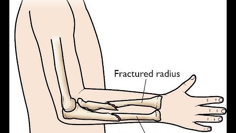 Fracture Closed treatment Radial and Ulnar CPT code - simplify medical coding