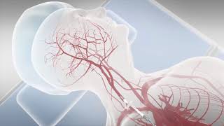 Transcarotid Artery Revascularization (TCAR)