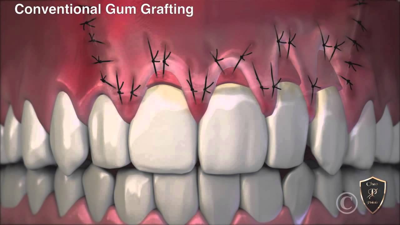Conventional Gum Grafting vs Chao Pinhole Surgical Technique Female
