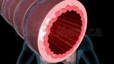 Chronic asthma - Animated Atlas