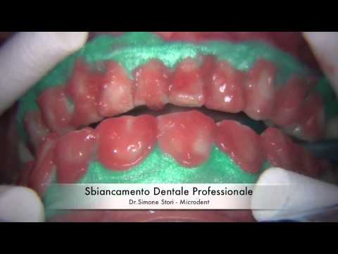 Sbiancamento Professionale dei Denti (Teeth Whitening)