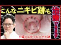 Acne Scars Raised Acne Scars Get Rid Of Your Worries With This Treatment Keloid Hypertrophic Acne Scars Raised Acne Scars Get Rid Of Your Worries With This Treatment Keloid Hypertrophic