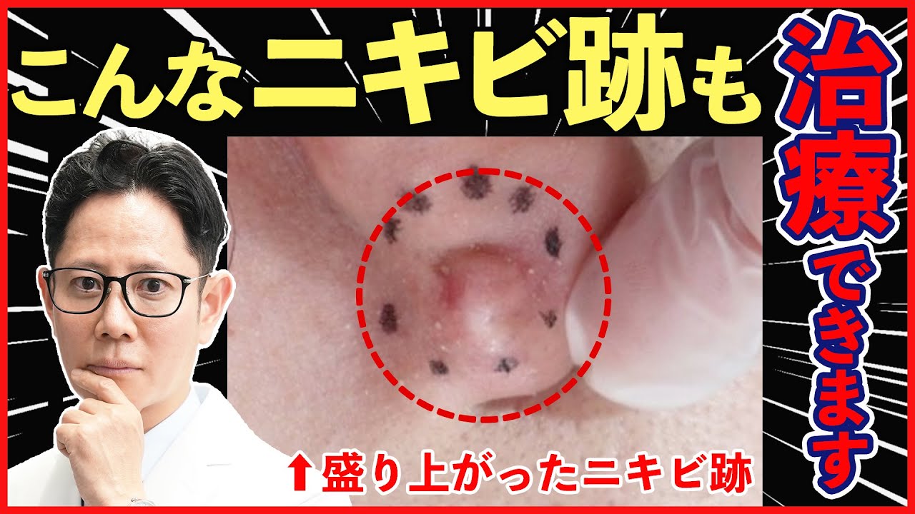 【ニキビ跡】盛り上がったニキビ跡。この治療法で悩みから解放【ケロイド・肥厚性瘢痕】