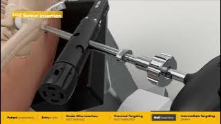 Intermediate Nail surgical animation | Gamma4 Hip Fracture Nailing System