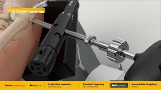 Intermediate Nail surgical animation | Gamma4 Hip Fracture Nailing System